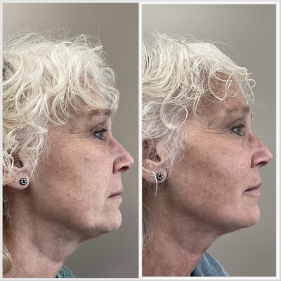 Before after liquid facelift Lizenka Adriaanse cosmetisch arts Rotterdam
