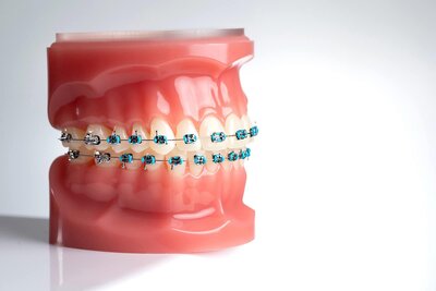 Looking for braces in Bryan College Station? At Brazos Valley Orthodontics we offer traditional metal braces and ceramic options to help you achieve a beautiful, confident smile. Schedule your consultation today!