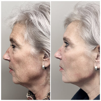 Before after liquid facelift Lizenka Adriaanse cosmetisch arts Rotterdam