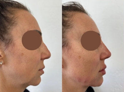 Before and after image showing Full Facial Rejuvenation results using dermal fillers at Refined Medical NY. This comprehensive treatment restores volume, smooths wrinkles, and enhances facial contours for a refreshed, youthful appearance.