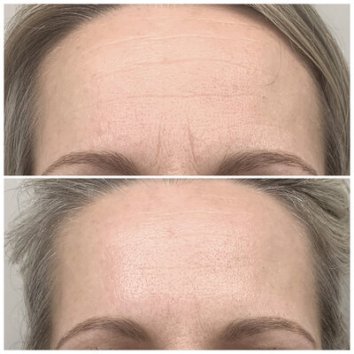 Botox before after door Lizenka Adriaanse cosmetisch arts Rotterdam