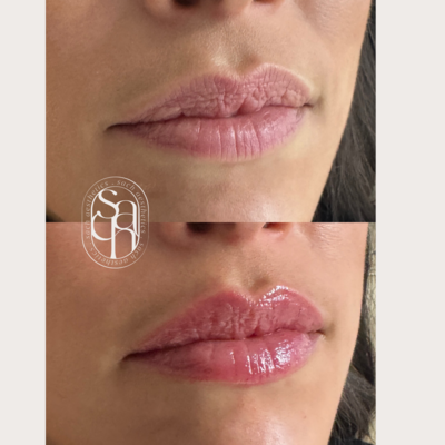 NYC NJ lip filler before and after indian south asian woman natural