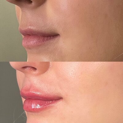 Lip filler injection services at Refresh Aesthetics