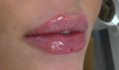 Close-up of natural lip enhancement with dermal filler in Orange County