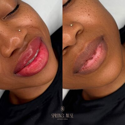 lips neutralization in New York