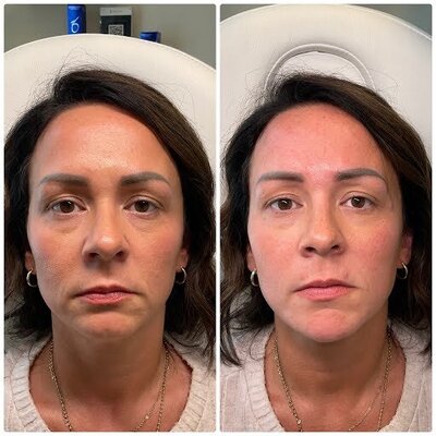 Virtue RF microneedling treatment in progress at a Chapel Hill skincare clinic.