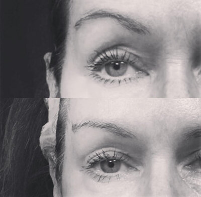 Before and after image showing Liquid Brow Lift results using neurotoxin injections at Refined Medical NY. This non-surgical treatment lifts and opens the eye area, creating a more youthful, refreshed appearance.