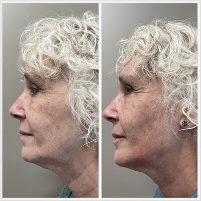 Liquid facelift door cosmetisch arts Lizenka Adriaanse in Rotterdam