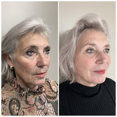 Before after liquid facelift Lizenka Adriaanse cosmetisch arts Rotterdam