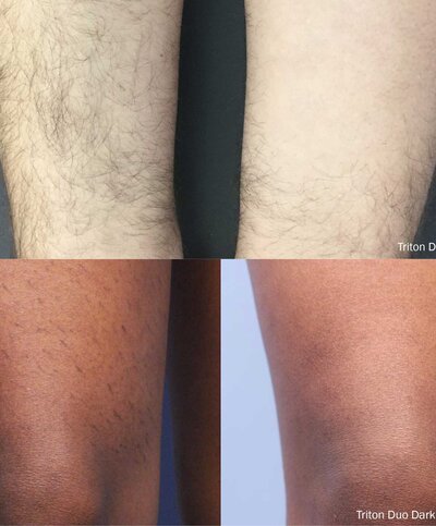 Ottawa's best cosmetic injectables clinic to get IPL Lumecca laser treatment