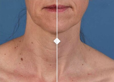 Before and after image showing the results of SkinPen microneedling on the decollete area at Refined Medical NY. This treatment helps to improve skin texture, reduce fine lines, and promote collagen production for smoother, rejuvenated skin.