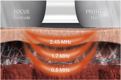 Sinclair's V-VR Core technology uses varying tissue depth that allows for customized treatments, from superficial layers to deeper muscular tissues making the treatment tailored the the person's specific concerns.