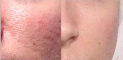 apparaillage jet peel visage