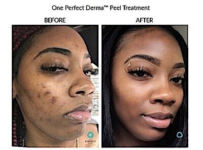 Before and after 1 Perfect Derma Peel for hyperpigmentation