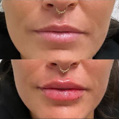 Before and after image showing Lip Enhancement results using dermal fillers at Refined Medical NY. This treatment adds volume, definition, and symmetry to create fuller, natural-looking lips.