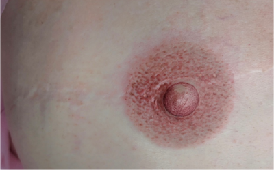 areola_after