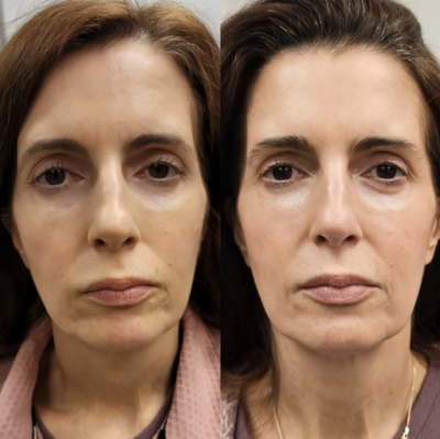 Botox and filler before after photo

