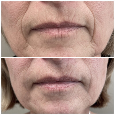 Lipfillers door cosmetisch arts Lizenka Adriaanse in Rotterdam