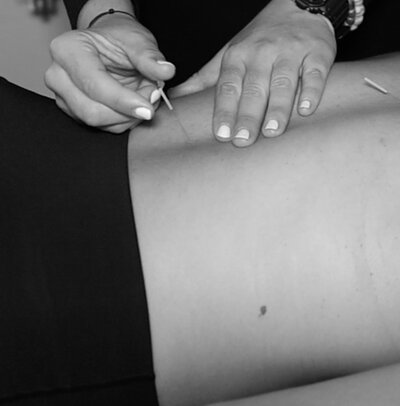 Black and white photo of acupuncturist gently inserting a needle into patient's back