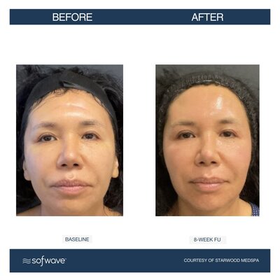 Set-57-Full-Face