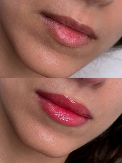 Lip Neutralization New York