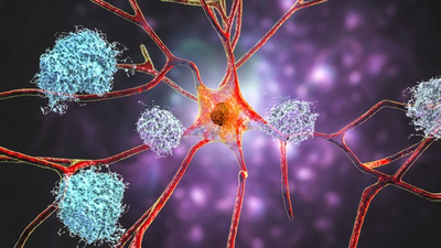 Illustration of a neuron surrounded by amyloid plaques, representing the biological process associated with Alzheimer's disease.