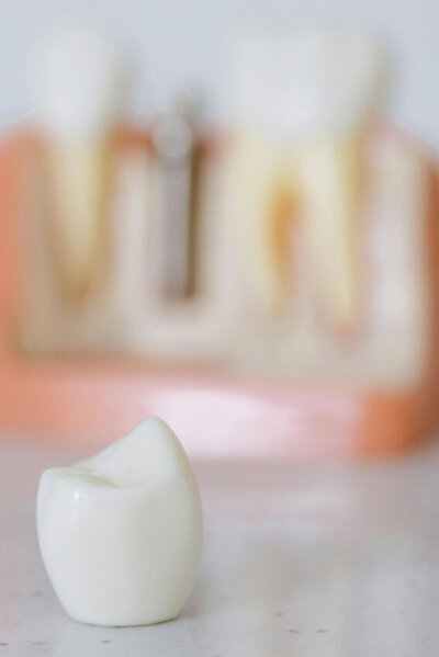 Dental crown for a tooth with decay.