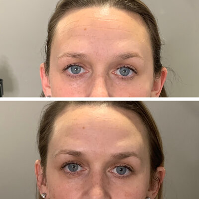 Botox treatment results from Refresh Aesthetics