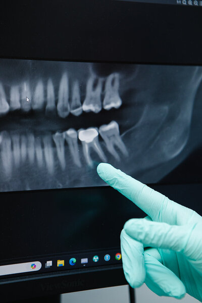 Prosthodontist reviewing and pointing at a dental implant X-ray, highlighting dental implants as a reliable solution at Peak Prosthodontics in Lethbridge, Alberta.