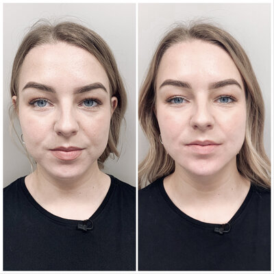 Liquid facelift kaaklijn Lizenka Adriaanse cosmetisch arts Rotterdam