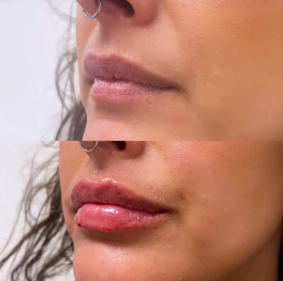 Before and after image showing lip filler enhancement results at Refined Medical NY. Dermal fillers are used to add volume, shape, and symmetry for smooth, natural-looking lips in East Setauket, Long Island.