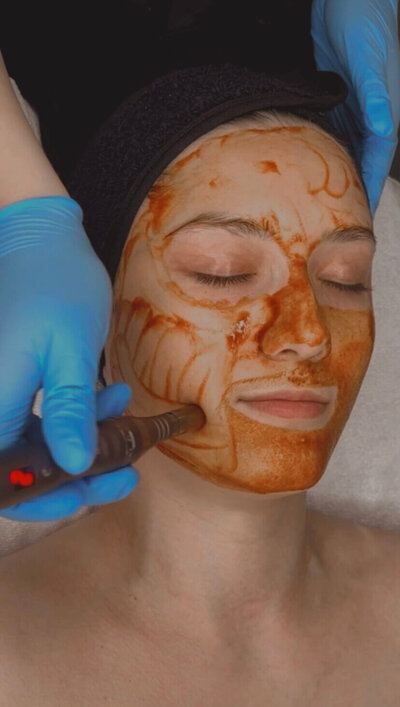 Ottawa and Gatineau's best cosmetic injectables clinic to get biorevitalization collagen boosting and stimulating medical-grade facial