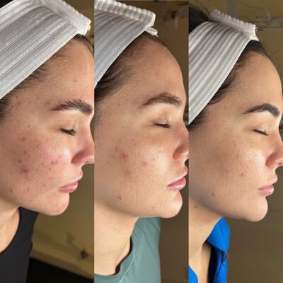 acne treatment progression 3 months