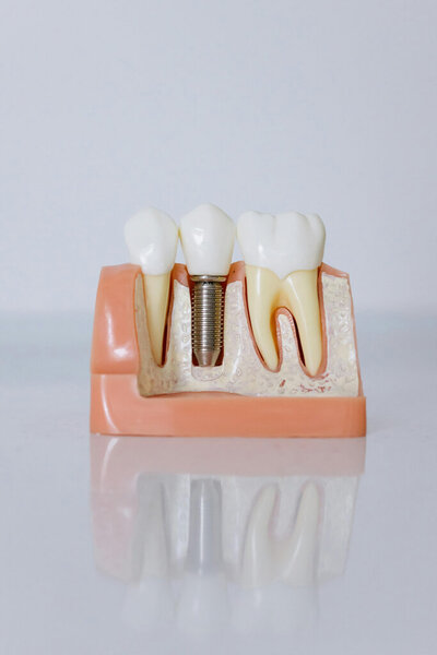 A model of a dental implant in Middleton, ID at Desert Hills Dental.