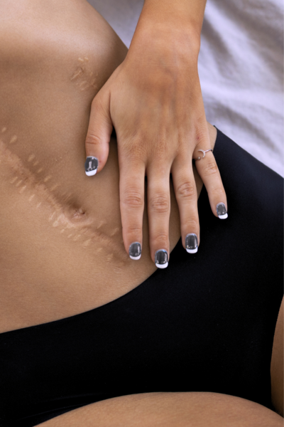 Stretchmark & Scar Camouflage is a treatment that uses flesh-tone inks to match your skin tone to conceal your scars and stretchmarks, making them less visible to the naked eye.