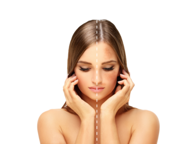 woman looking down with her hands resting near her cheeks with one half of her with clear skin and one half of her with melasma