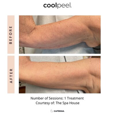 CoolPeel before and after photo arms