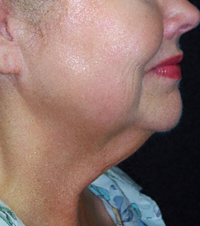 Beauty and Grace Aesthetics Botox patient before and after