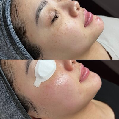 Ice Globe Facial in Santa Clara, CA