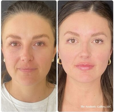 Asethetic Gallery Facial Rejuvenation in Northern Colorado