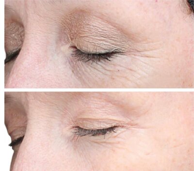 Before and after image showcasing the results of the VI Peel Advanced at Refined Medical NY. This treatment targets deeper skin issues, helping to reduce wrinkles, acne scars, and hyperpigmentation for a smoother, more youthful complexion.