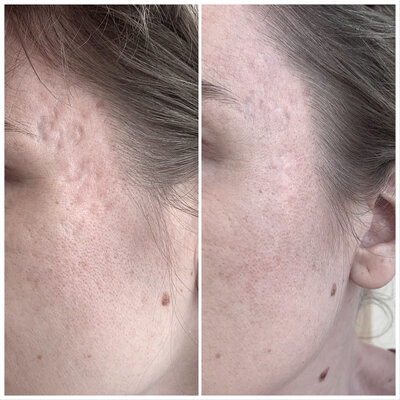 Fillers mondhoeken door cosmetisch arts Lizenka Adriaanse in Rotterdam