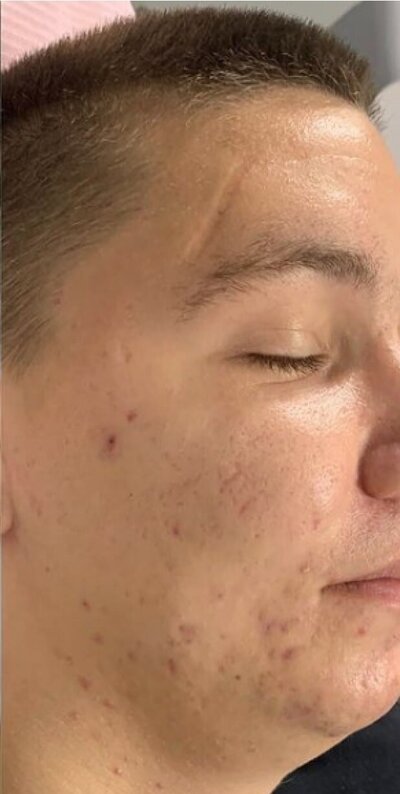 avant après du jet peel