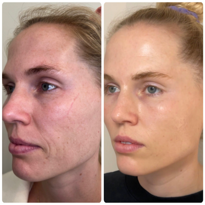 Moxi laser rejuvenation treatment being performed at a Chapel Hill aesthetics practice.