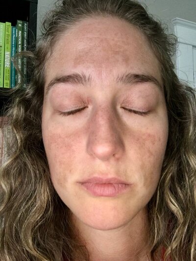 woman with dark patches of melasma on both cheeks and forehead