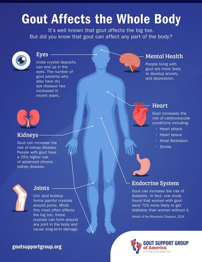 Gout Affects the Whole Body Infographic by Gout Support Group of America