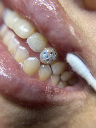 Tooth gems available at Syked about Beauty there are multiple gems applied to one tooth and its very sparkly