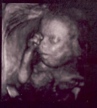 Cole Sonogram