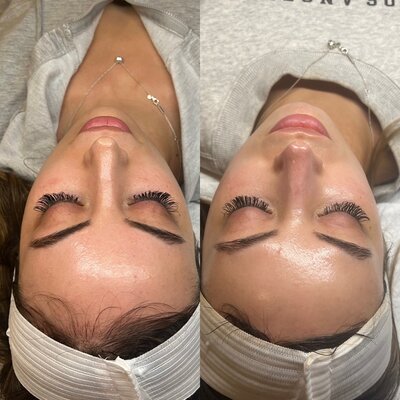 microneedling 3 sessions