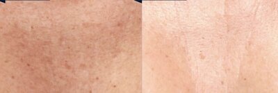 apparaillage jet peel visage